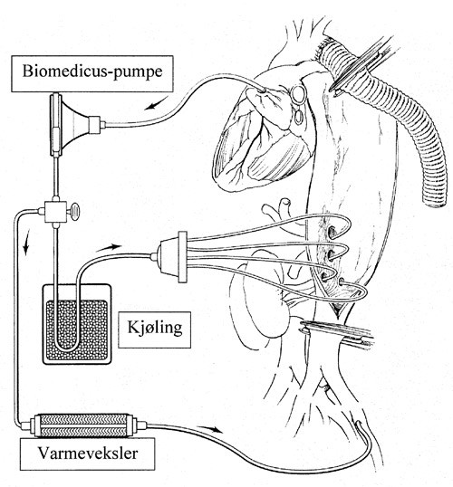 Figur 3  Skjematisk fremstilling av partiell ekstrakorporal sirkulasjon med sidel&oslash;p for &aring; perfundere nyrearteriene og de&hellip;
