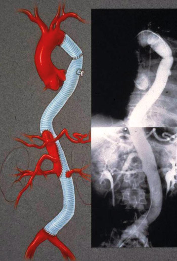 Figur 4  Til venstre: Skjematisk fremstilling av en ferdig utf&oslash;rt torakoabdominal aortareseksjon med implantasjon av protese&hellip;