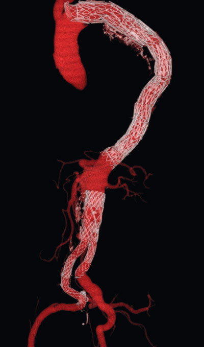 Figur 6  Stentgraftbehandling for et torakoabdominalt aortaaneurisme p&aring; basis av type B-aortadisseksjon. Denne pasienten&hellip;