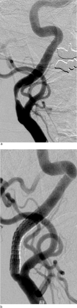 Figur 2   Endovaskul&aelig;r behandling av arteria carotis. a) Angiografisk fremstilling av stenose. b) Etter implantasjon av stent