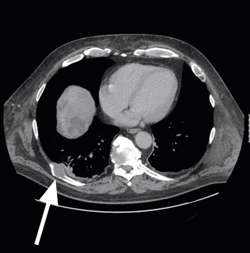Figur 3  CT-unders&oslash;kelse av thorax viste metastase baktil i h&oslash;yre niende ribbein
