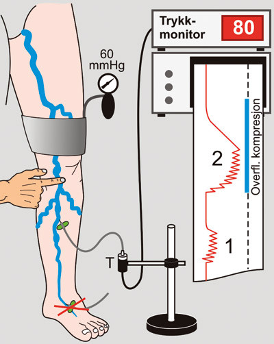 Figur 2  Skjematisk illustrasjon av venetrykksm&aring;ling under gange hos pasient med ven&oslash;s insuffisiens. Varik&oslash;s vene kanyleres&hellip;