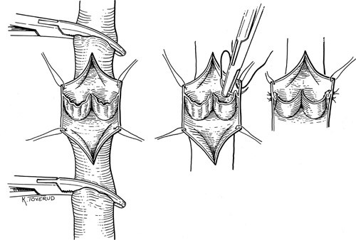 Figur 2  Intern veneklaffplastikk: Venen &aring;pnes p&aring; langs (venotomi) for &aring; visualisere veneklaffene. Slakke klaffer&hellip;