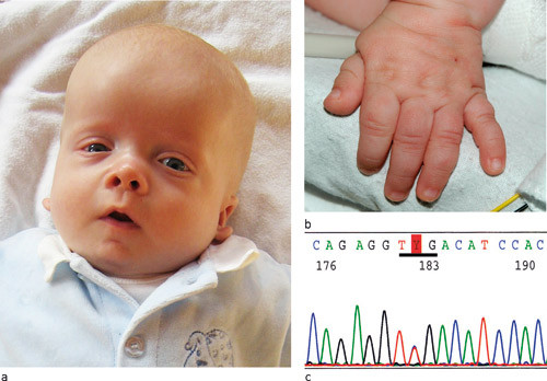 Figur 3  a) Pasient 2 med Noonans syndrom, komplisert medf&oslash;dt hjertefeil inkludert hypertrofisk kardiomyopati og mutasjon i&hellip;