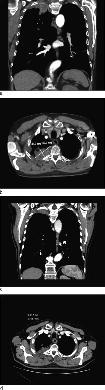 Figur 2  a, b) CT thorax av tumor ved diagnosetidspunktet med innvekst i tilliggende strukturer. c, d) St&oslash;rrelsesreduksjon&hellip;