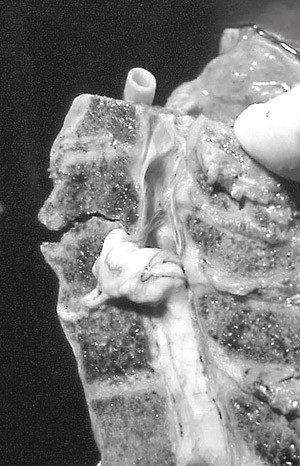 Figur 2  Sagittalt snitt gjennom cervikalcolumna (anatomisk preparat) som viser ruptur av mellomvirvelskiven som f&oslash;lge av&hellip;