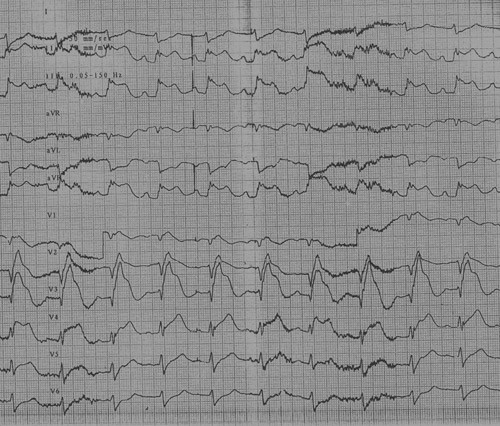 Figur 2  EKG ved innkomst med ST-elevasjon i flere avledninger