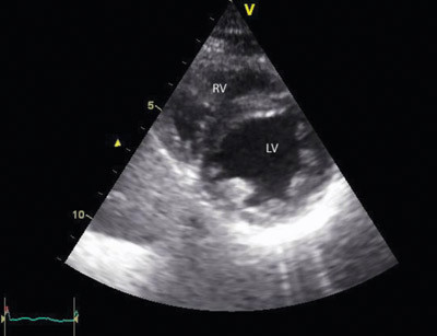 Figur 4  Ekkokardiografisk endediastolisk kortaksebilde ti dager etter innkomst. Venstre ventrikkel (LV) har n&aring; en diameter&hellip;