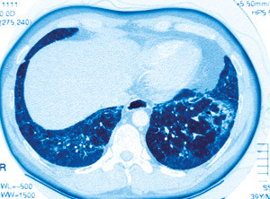 Idiopatisk lungefibrose. Illustrasjonsfoto &copy; James Cavallini/Photo Researchers/GV-Press/NordicPhotos