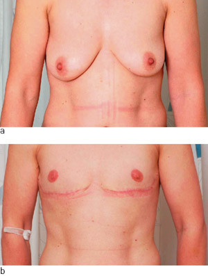 Figur&nbsp;3&nbsp;&nbsp;a) Bryster med moderat grad av heng (ptose) f&oslash;r operasjon. &nbsp;b) &Eacute;n m&aring;ned etter mastektomi og forflytning av areola&hellip;