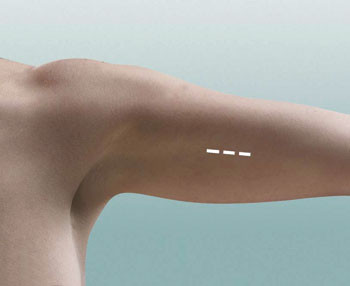 Figur 2  Implantatet appliseres subdermalt p&aring; medialsiden av den ikke-dominante overarmen 6&thinsp;&ndash;&thinsp;8 cm over albuleddet like&hellip;