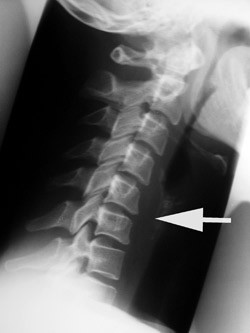 Figur 1  &laquo;Normalt&raquo; resultat, selv om pasienten har nakkesmerter. Bildet er tatt ca. fire m&aring;neder etter skaden