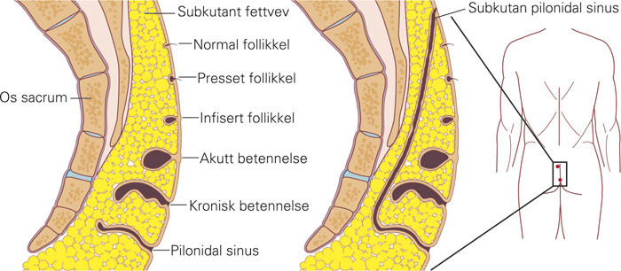Figur 1  Patogenese ved pilonidal sykdom. Figuren gjenspeiler ulike faser som kan forekomme ved pilonidal sykdom. &Oslash;verst ses&hellip;