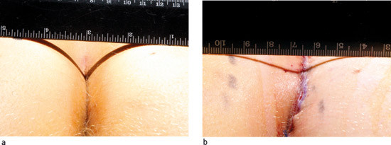 Figur 3  Avflatingen av den dype intergluteale kl&oslash;ften, f&oslash;r (a) og etter (b) Bascoms kl&oslash;ft-l&oslash;ft-operasjon