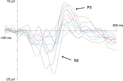 11 friske personers hjerneaktivitet knyttet til stavelsen /ta/ som ble aktivt oppdaget blant standardstavelsen /ba/ &hellip;