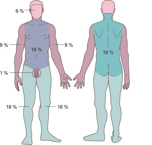 Figur 1  Klinisk vurdering av skadeutbredelse hos voksen pasient &ndash; &laquo;nierregelen&raquo;