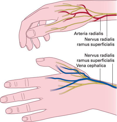 Figur 1  De overflatiske grenene av nervus radialis er utsatt for stikkskade i forl&oslash;pet langs arteria radialis og idet&hellip;