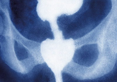 Rektalt karsinom. Illustrasjonsfoto &copy; James Cavallini /BSIP/GV-Press/NordicPhotos