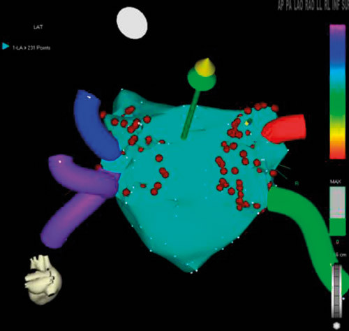 Figur 2  Tredimensjonalt rekonstruert bilde av venstre atrium med lungevener. De hvite punktene angir mekanisk kontakt med&hellip;