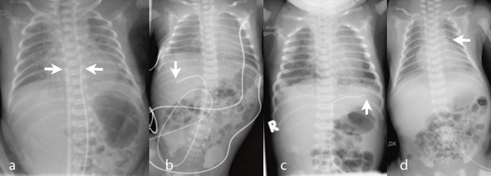 Figur 1  a) Riktig plassering av navlevenekateter (lavt i h&oslash;yre atrium; venstre pil) og navlearteriekateter (Th7; h&oslash;yre pil)&hellip;