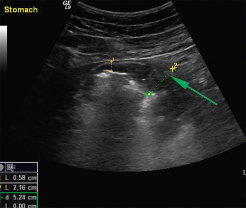 Figur 1  Transabdominal ultralyd (venstre) viser betydelig fortykket, foldet ventrikkelvegg. Tykkelsen er opp mot 2 cm &hellip;