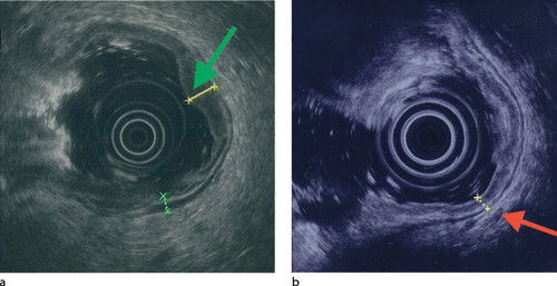 Figur 3  Endoskopisk ultralyd tatt a) 14 dager etter oppstart av antiviral behandling viser fortsatt fortykket&hellip;