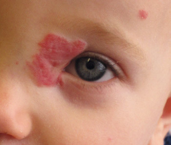 Figur 3  Hemangiomet etter 25 ukers behandling med propanolol