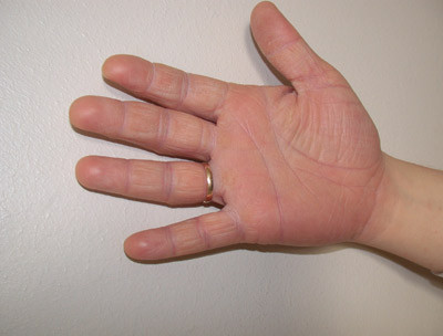 Figur 4  Pasienten utviklet etter tre d&oslash;gn palmart erytem