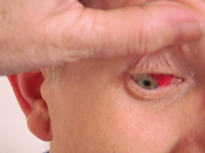 Figur 5  Markert konjunktival injeksjon/bl&oslash;dning i h&oslash;yre &oslash;ye