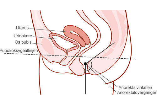 Figur 3  Illustrasjon av den anorektale vinkel som utgj&oslash;res av aksen av rectum og aksen av analkanalen. Videre ser vi&hellip;
