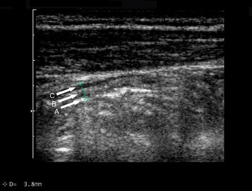Figur 2  Colon transversum (B-mode, 7,5 MHz) hos pasient med ulcer&oslash;s kolitt. Veggen er fortykket til 3,8 mm, mens&hellip;