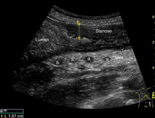 Figur 3  Pasient med Crohns sykdom. Bildet er tatt i nedre venstre kvadrant (B-mode, 4 MHz) og viser et stenotisk parti i&hellip;