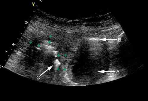 Figur 4  Pasient med Crohns sykdom (B-mode, 4 MHz). Pil A viser urinbl&aelig;ren og pil B luft &oslash;verst i bl&aelig;ren, noe som antyder at&hellip;
