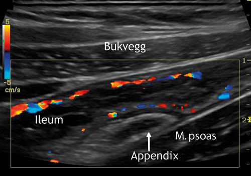 Figur 6  Pasient med Crohns sykdom. Bildet er tatt i h&oslash;yre regio iliaca (B-mode 8 MHz, doppler 5,0 MHz) og viser fortykket&hellip;