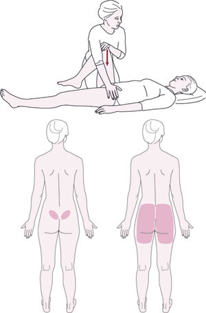Figur 1  Smerteprovokasjon av bakre bekken (P4-test). Pasienten ligger p&aring; ryggen med det ene beinet strakt og det andre&hellip;
