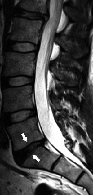 Figur 1  Sagittalt T2-vektet bilde av lumbosakralcolumna som viser lett grad av skivedegenerasjon med m&oslash;rk skive (piler) i&hellip;