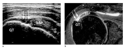 Figur 3  Gjennomg&aring;ende (full tykkelse) ruptur av rotatorcuffen. a) Ultralyd viser gjennomg&aring;ende ruptur (piler) ved festet av&hellip;