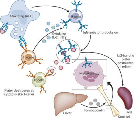 Figur 1  Patofysiologiske mekanismer ved immunologisk trombocytopeni. Glykoproteinene (GPIIb-IIIa/GPIb) nedbrytes til&hellip;