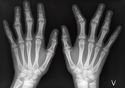 Figur 2b  R&oslash;ntgen av hendene til pasient 4 demonstrerer skjevstilling i flere ledd, s&aelig;rlig 2. finger, h&oslash;yre h&aring;nd samt&hellip;