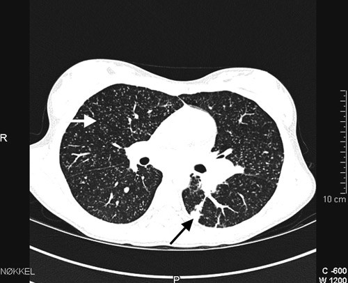 Figur 2  H&oslash;goppl&oslash;ysings-CT av thorax tatt f&oslash;r behandlingsstart viser multiple sm&aring; noduli med tilfeldig distribusjon i b&aring;e&hellip;