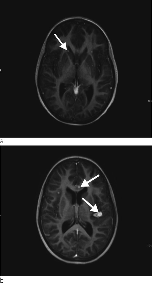 Figur 3  MR av cerebrum med kontrast. a) Bilete tatt f&oslash;r behandlingsstart viser multiple sm&aring; kontrastladande lesjonar i&hellip;