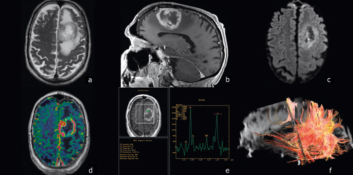 Figur 1  I tillegg til konvensjonelle MR-sekvenser som T2 (a) og T1 etter kontrast (b) brukes avanserte MR-metoder i&hellip;