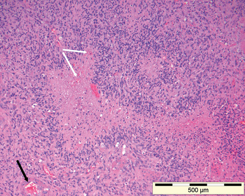 Figur 2  Glioblastom (WHO-grad IV) med typiske histologiske kjennetegn: girlanderformede nekroser (svart pil) og&hellip;
