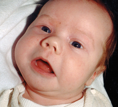 Figur 1  Asymmetrisk nakkestilling hos spedbarn. Det er gitt tillatelse til publisering av bildet. Foto privat