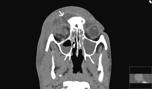 Figur 2  Abscessutvikling sett p&aring; CT med kontrast tatt etter ankomst regionsykehuset