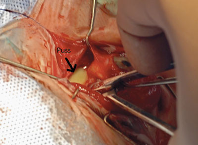 Figur 5  Abscessen funnet, man spriker med peang retrobulb&aelig;rt