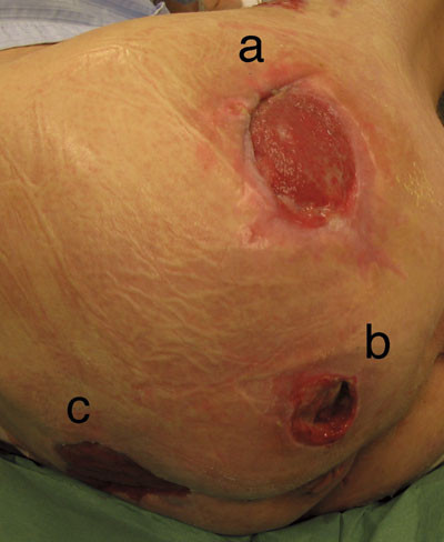 Figur 1  Paraplegisk pasient som har utviklet et ca. 10 cm stort trykks&aring;r (grad 3) over trochanter major (a), et ca. 5 cm&hellip;