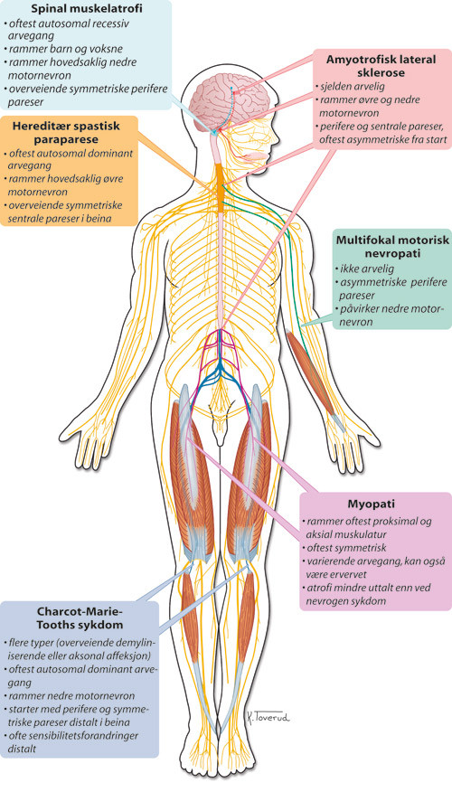 Figur 1  Skjematisk fremstilling av &oslash;vre og nedre motornevron. Prim&aelig;r anatomisk lokalisasjon for sykdommer som er omtalt i&hellip;