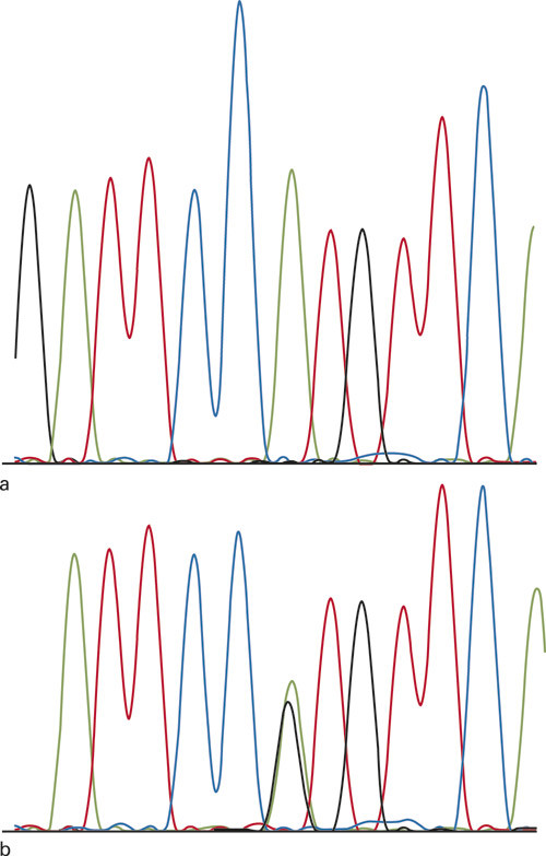 Figur 2  Sekvensering av det aktuelle omr&aring;det i SOD1-genet. a) En normal nukleotidsekvens med adenosin i homozygot form i&hellip;