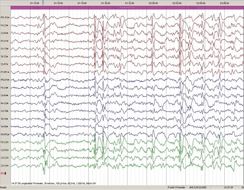 Figur 1  Utbrudd av langsomt generalisert pigg-b&oslash;lge-m&oslash;nster i EEG hos en v&aring;ken pasient med Lennox-Gastauts syndrom